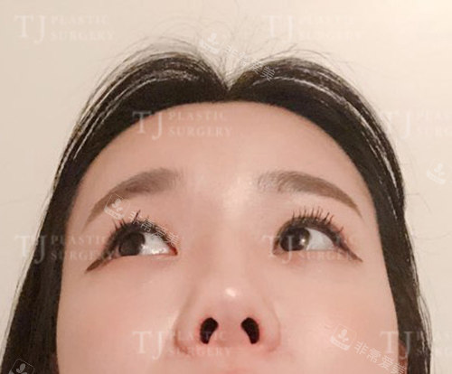 韩国TJ整形外科鼻翼缩小手术
