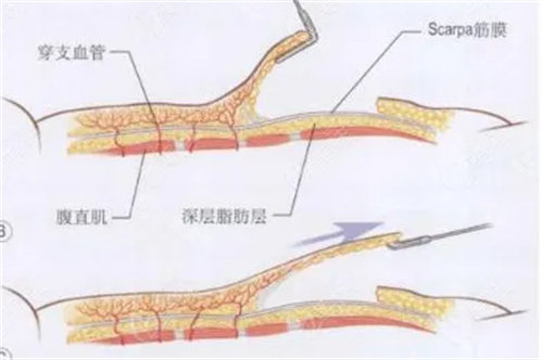 腹壁整形剝離方法展示圖