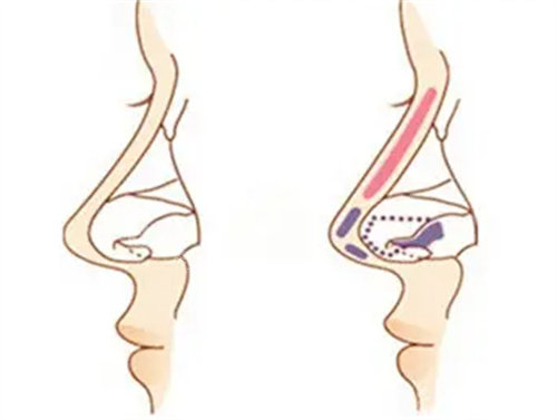 假体隆鼻具体操作展示图