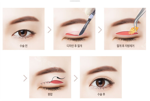 韩国芭堂双眼皮过程图