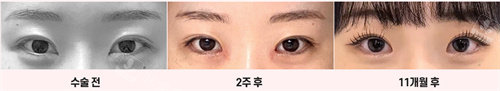 雙眼皮病例對比 雙眼皮病例對比