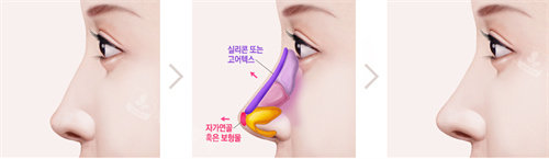 隆鼻术法图