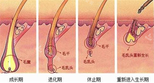 毛发种植示意图