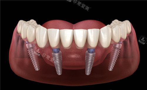 上海全口种植牙收费价目表,鼎植/雅悦/永华口腔种牙不贵!
