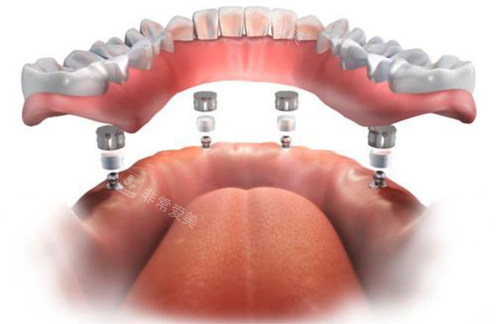 半口种植牙图示