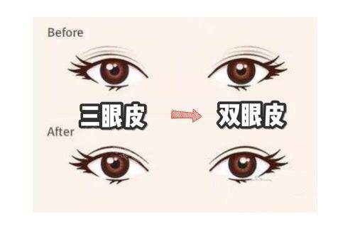 韓國(guó)來(lái)麗整形醫(yī)院雙眼皮修復(fù)圖