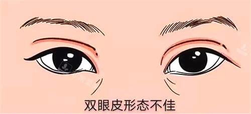 新疆整形醫(yī)院眼部整形圖 新疆整形醫(yī)院眼部整形圖