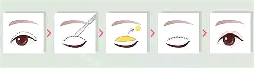 新疆整形醫(yī)院雙眼皮手術(shù)示意圖 新疆整形醫(yī)院雙眼皮手術(shù)示意圖