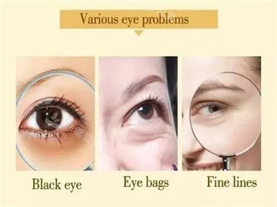 黑眼圈淚溝細紋等眼部問題舉例 黑眼圈淚溝細紋等眼部問題舉例