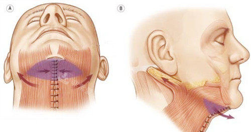 颈阔肌成形术图示