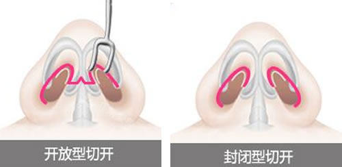 韩国NJH卢钟勋整形隆鼻特点介绍