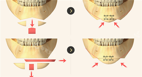 下頜角整形手術(shù)方式圖