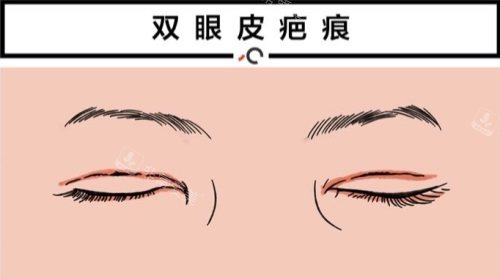 双眼皮疤痕修复 双眼皮疤痕修复