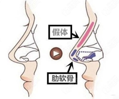 隆鼻示意图