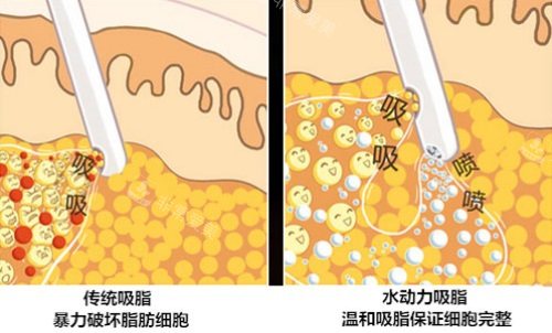 传统吸脂与水动力吸脂对比图 传统吸脂与水动力吸脂对比图