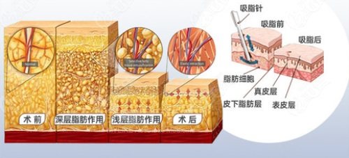 吸脂前后对比图 吸脂前后对比图