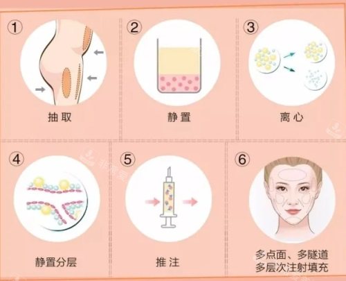 脂肪填充过程图 脂肪填充过程图