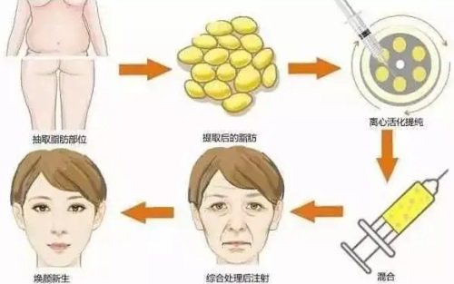 脂肪填充详细图解 脂肪填充详细图解