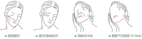埋線提升能解決的問題 埋線提升能解決的問題
