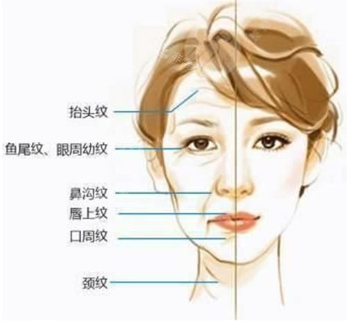 面部皺紋示意圖 面部皺紋示意圖