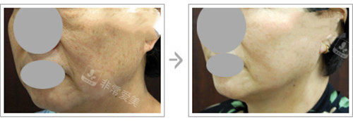 韩国EVE整形医院面部肤质提升对比示意图