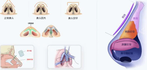 鼻子整形动画示意图