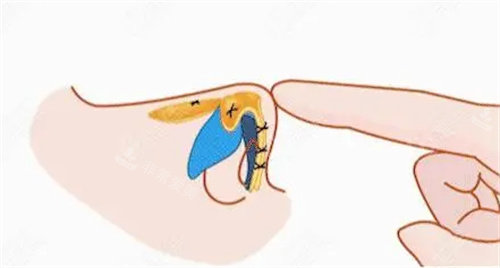 隆鼻术后触感动画图 隆鼻术后触感动画图