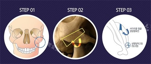韓國Faceplus整形醫(yī)院步驟圖