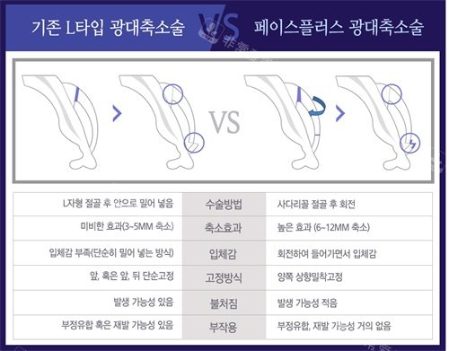 韩国Faceplus整形医院颧骨整形与普通颧骨整形区别