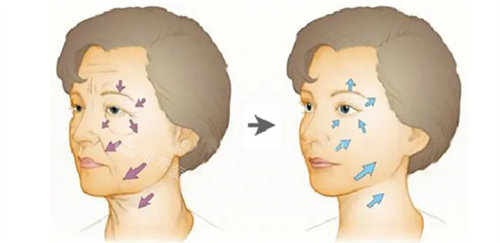 面部拉皮手术前后对比图