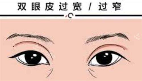烏魯木齊華美整形醫(yī)院雙眼皮示意圖 烏魯木齊華美整形醫(yī)院雙眼皮示意圖