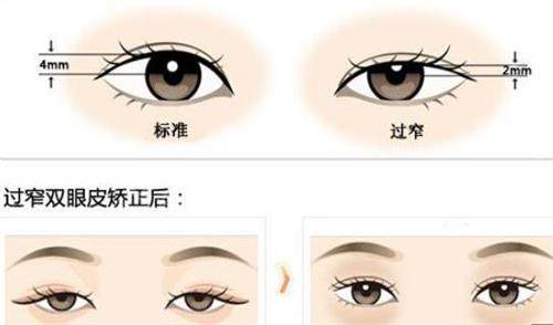烏魯木齊華美整形醫(yī)院眼部整形圖 烏魯木齊華美整形醫(yī)院眼部整形圖