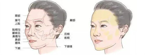 面部脂肪分布细节说明图 面部脂肪分布细节说明图