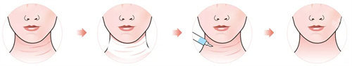 非手术方式祛颈纹方法展示图
