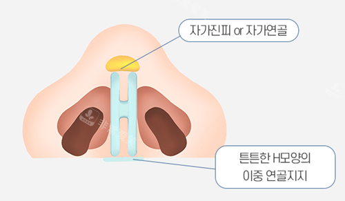 鼻子修复软骨位置设计图示