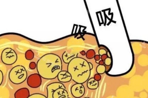 抽脂手术卡通图 抽脂手术卡通图