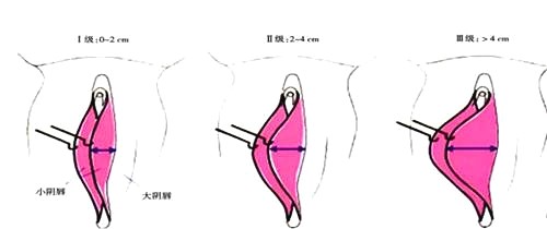 烏魯木齊華美整形醫(yī)院私密手術(shù)圖