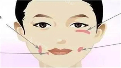 酒窩示意圖 酒窩示意圖
