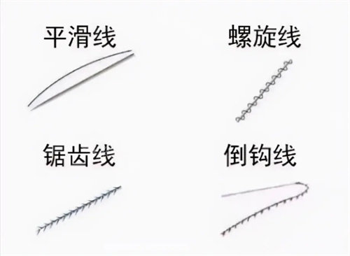 埋線提升示意圖 埋線提升示意圖