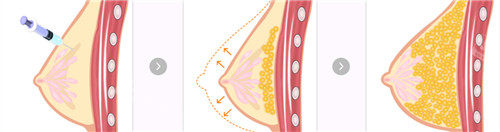 脂肪丰胸手术后变化图