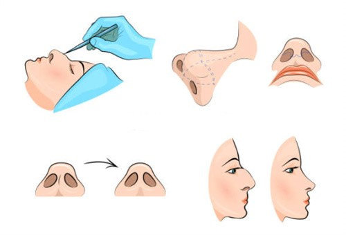 隆鼻手術(shù)過程圖
