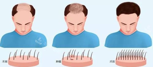 植發(fā)術(shù)前術(shù)后對(duì)比圖 植發(fā)術(shù)前術(shù)后對(duì)比圖