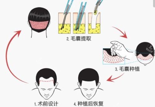 植發(fā)毛囊提取示意圖 植發(fā)毛囊提取示意圖