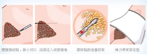 腰腹吸脂示意圖