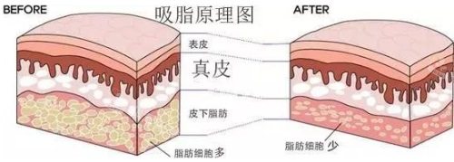 吸脂原理图 吸脂原理图