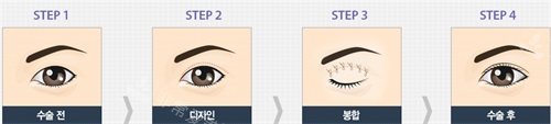 韩国Faceplus整形医院双眼皮手术过程