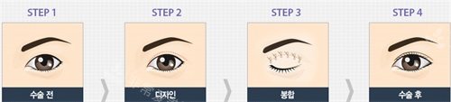 韓國Faceplus整形醫(yī)院雙眼皮手術(shù)過程
