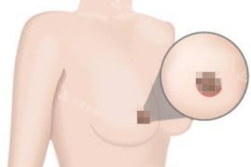 乳暈切開(kāi)法卡通圖 乳暈切開(kāi)法卡通圖