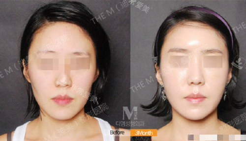 韓國迪美面部脂肪填充真人實例 韓國迪美面部脂肪填充真人實例