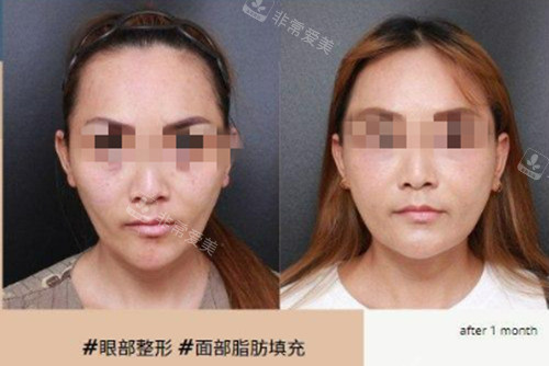 韓國VG百利酷面部脂肪填充真人實例 韓國VG百利酷面部脂肪填充真人實例